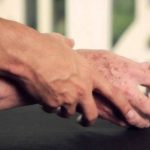 Έφτιαξαν νευρώνες από ανθρώπινο δέρμα για την θεραπεία του Πάρκινσον