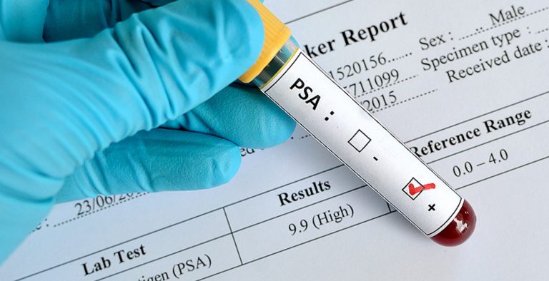 Αρνητικοί οι Έλληνες σε εξέταση για τον καρκίνο του προστάτη