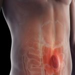 Οι κήλες κοιλιακών τοιχωμάτων και πώς θεραπεύονται