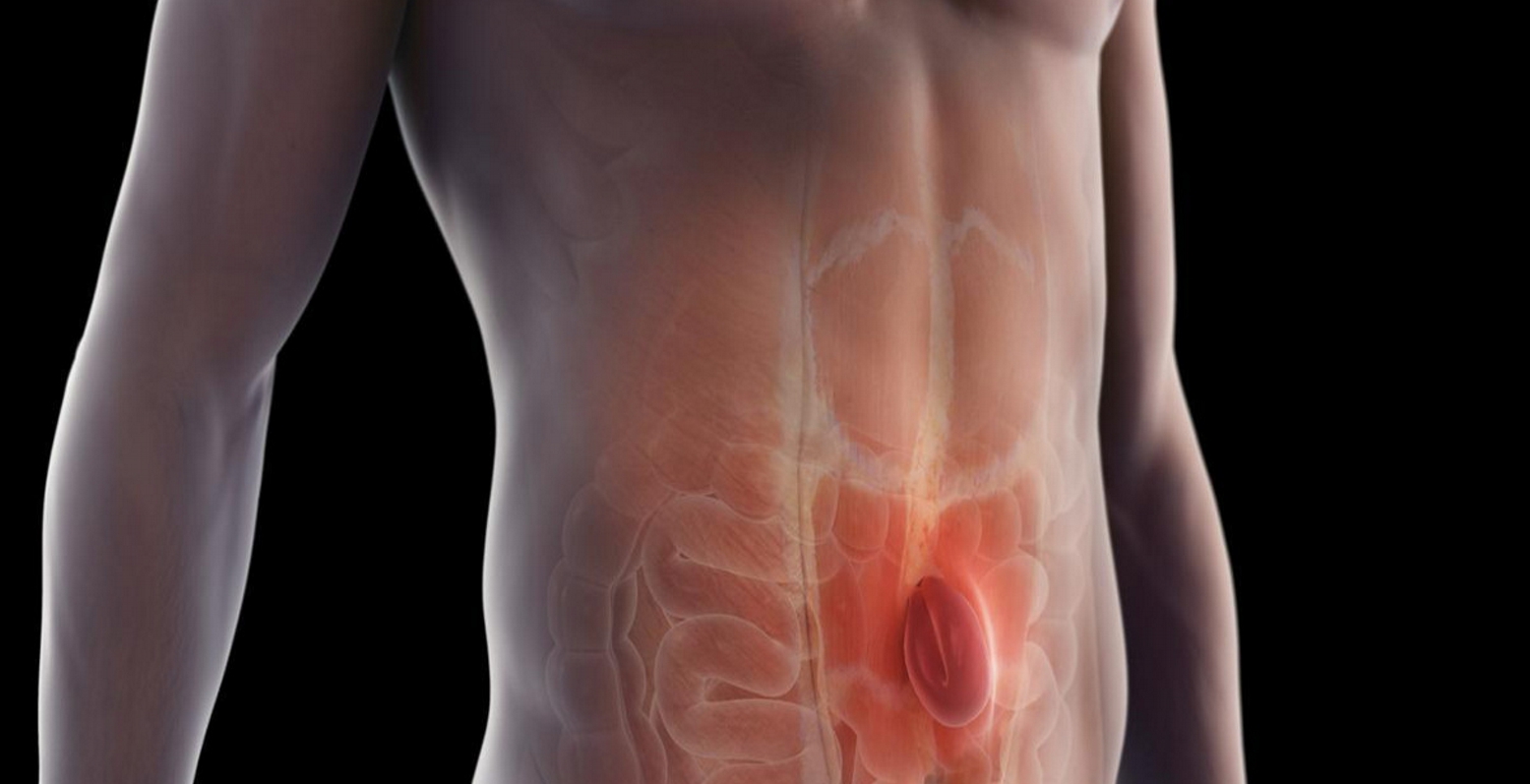 Οι κήλες κοιλιακών τοιχωμάτων και πώς θεραπεύονται