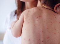 Επιδημία ιλαράς: 2916 κρούσματα στην Ελλάδα