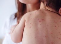 Ιλαρά: Οι ΗΠΑ κινδυνεύουν με επιστροφή ευρείας επιδημίας 