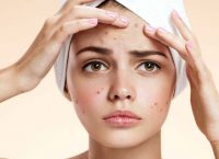 Σπυράκια: Τι να κάνετε για να απαλλαγείτε μια και καλή