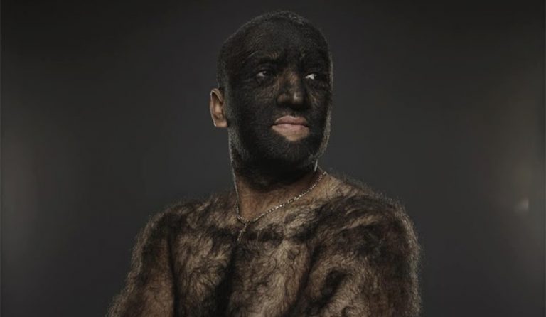 Λάρι Γκόμεζ: Ο “λυκάνθρωπος” ή αλλιώς ο πιο τριχωτός άνθρωπος στον κόσμο (pics & vid)