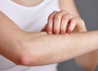 Έρευνα: Το έκζεμα συνδέεται με καρδιακές παθήσεις και εγκεφαλικά