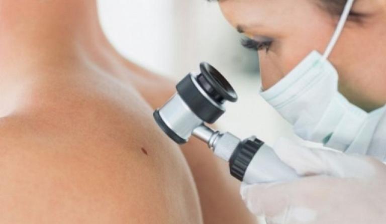 Σημαντική μείωση των θανάτων από μελανώματα μέχρι το 2050