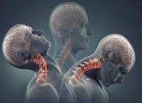 Αυχενικό σύνδρομο: Αίτια και συμπτώματα