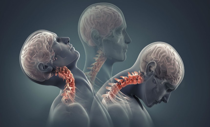 Αυχενικό σύνδρομο: Αίτια και συμπτώματα