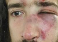Αυτός είναι ο 28χρονος Βαγγέλης που χτύπησαν φασίστες στο Πέραμα – Σοκάρουν τα τραύματά του (pic)