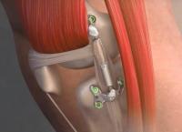 Πρωτοποριακή χειρουργική επέμβαση εμφύτευσης στις ΗΠΑ