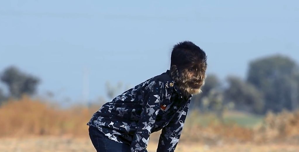 Αγόρι “λυκάνθρωπος”: Η σπάνια ασθένεια από την οποία πάσχει ένα παιδί στην Ινδία (vid)