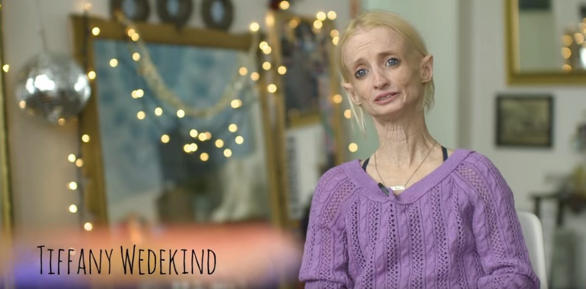 Η γυναίκα “Benjamin Button” – Η απίστευτη ιστορία της (vid)