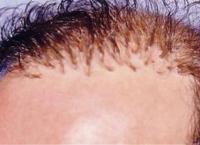 Εμφύτευση μαλλιών: Δερματολόγοι 70 χωρών καλούν τον κόσμο να μην κάνει στην Τουρκία