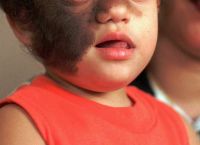 Σύνδρομο του λυκανθρώπου: Λάθος αγωγή σε φάρμακο προκάλεσε υπερτρίχωση σε 17 παιδιά στην Ισπανία