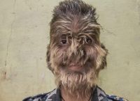 Ένα αγόρι «λυκάνθρωπος» ζει στην Ινδία (vid)