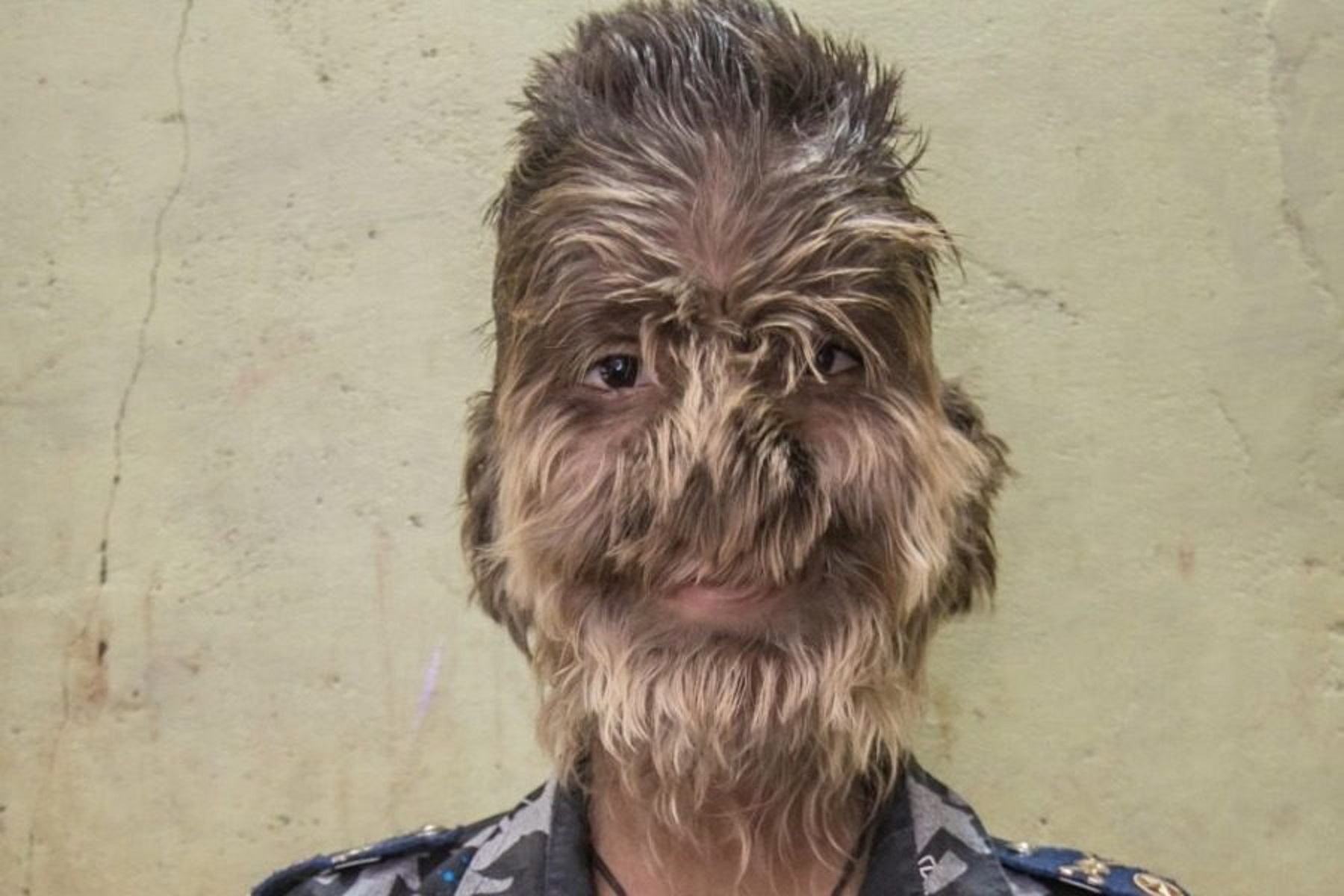 Ένα αγόρι «λυκάνθρωπος» ζει στην Ινδία (vid)