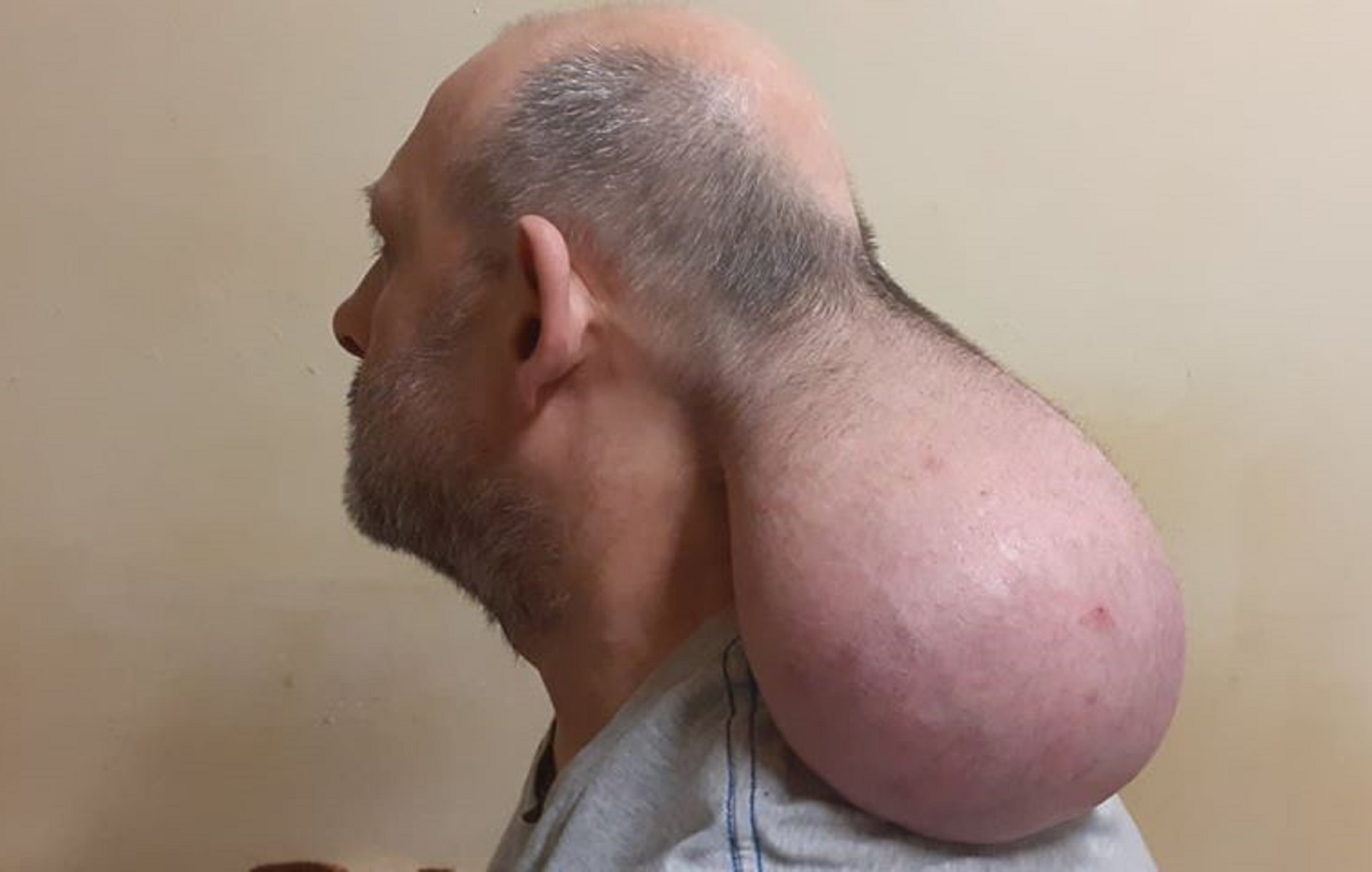 Φυλακές Νιγρίτας: Σοκάρει η εικόνα Βούλγαρου κρατούμενου – “Έβγαλα 2ο κεφάλι” [vid]