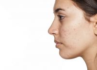 Πως να εξαφανίσω τα σπυράκια σε λίγες ώρες