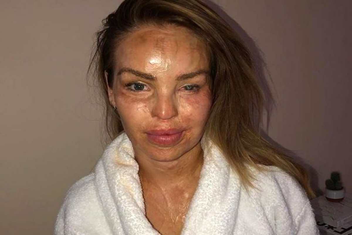 Katie Piper: Η επίθεση με βιτριόλι που της άλλαξε για πάντα τη ζωή