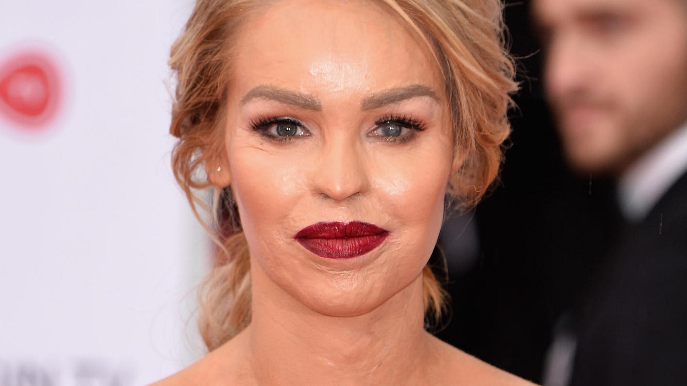 Katie Piper: To μοντέλο που δέχθηκε επίθεση με βιτριόλι