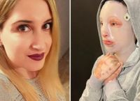 Επίθεση με βιτριόλι: Η συγκλονιστική ανάρτηση της 32χρονης Ιωάννας