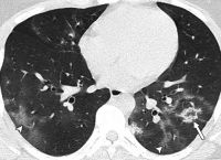 Μαγιορκίνης: Οι βλάβες που αφήνει ο κορωνοϊός σε ανεμβολίαστους ανήλικους