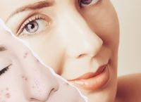 Σπυράκια: Πως να τα αντιμετωπίσετε