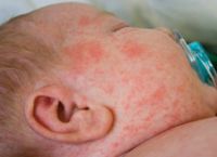 Ιλαρά: Εκατομμύρια μωρά έχασαν την πρώτη δόση εμβολίου