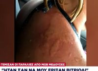 Μωβ μέδουσα: Μαρτυρία γυναίκας από επίθεση της μέδουσας “Με τσίμπησε και ήταν λες και μου έριξαν βιτριόλι”