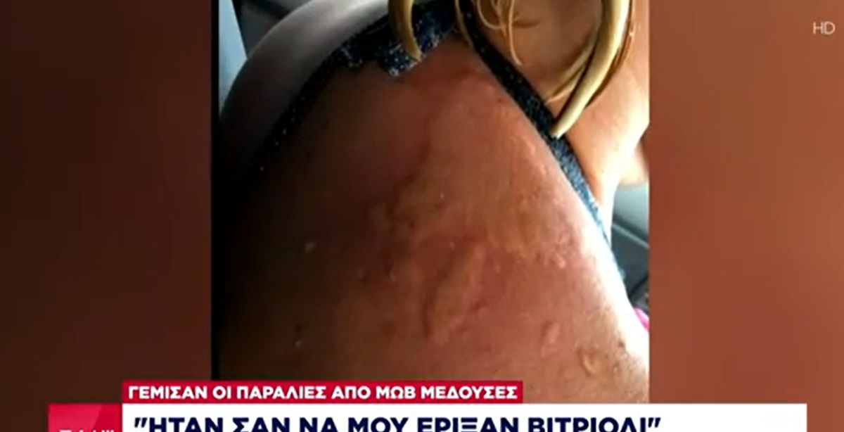 Μωβ μέδουσα: Μαρτυρία γυναίκας από επίθεση της μέδουσας “Με τσίμπησε και ήταν λες και μου έριξαν βιτριόλι”