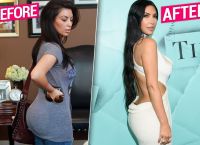 Kim Kardashian: Αφαίρεσε τα εμφυτεύματα από στήθος της και από τα οπίσθια