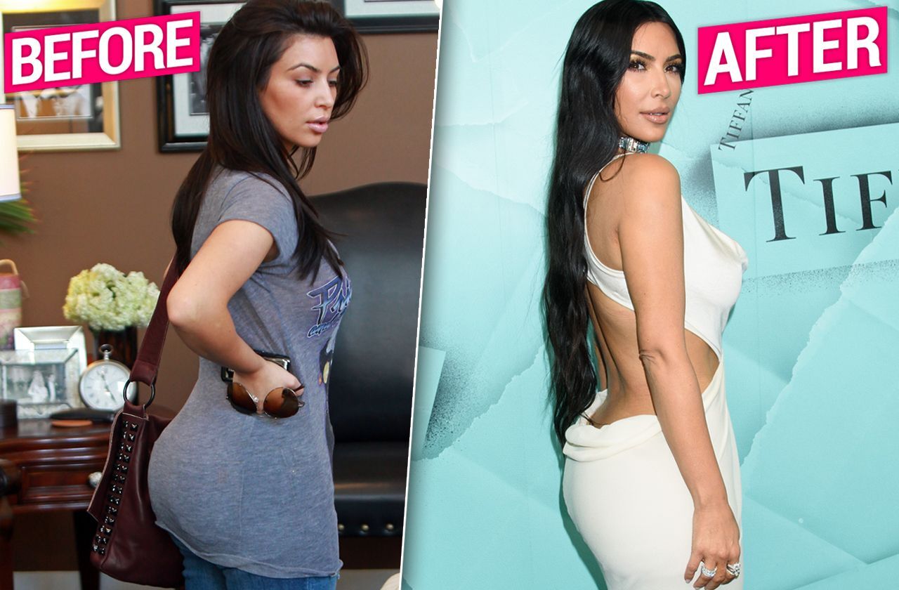 Kim Kardashian: Αφαίρεσε τα εμφυτεύματα από στήθος της και από τα οπίσθια