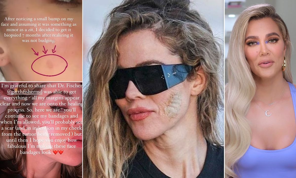 Khloe Kardashian: Μιλάει ανοιχτά για τον όγκο στο προσωπό της – Φόβοι για καρκίνο του δέρματος