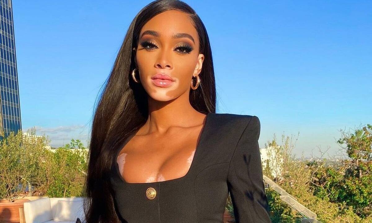 Winnie Harlow: Η γυμνή  φωτογράφιση της που μας άφησε με το στόμα ανοιχτό