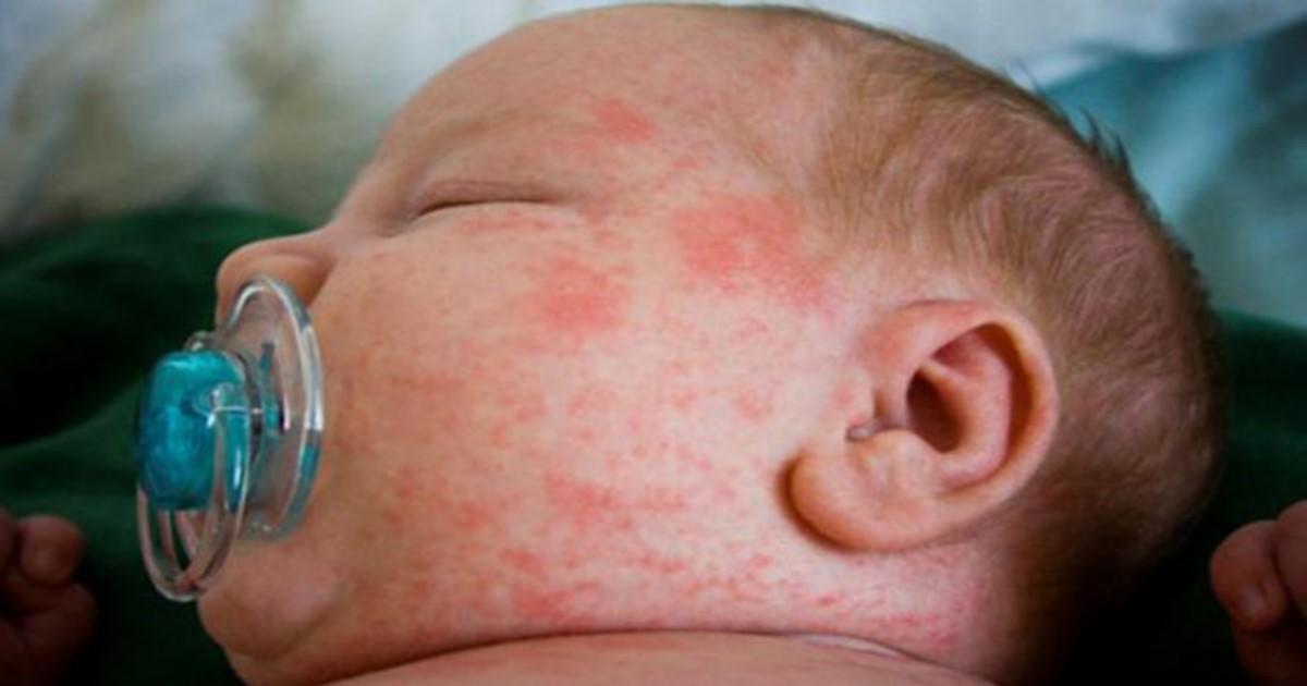 Θεσσαλονίκη: Ο επτάχρονος ήταν το έκτο θανατηφόρο κρούσμα στρεπτόκοκκου φέτος