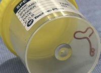 Ζωντανό σκουλήκι, 8 εκατοστών, βρέθηκε στον εγκέφαλο γυναίκας