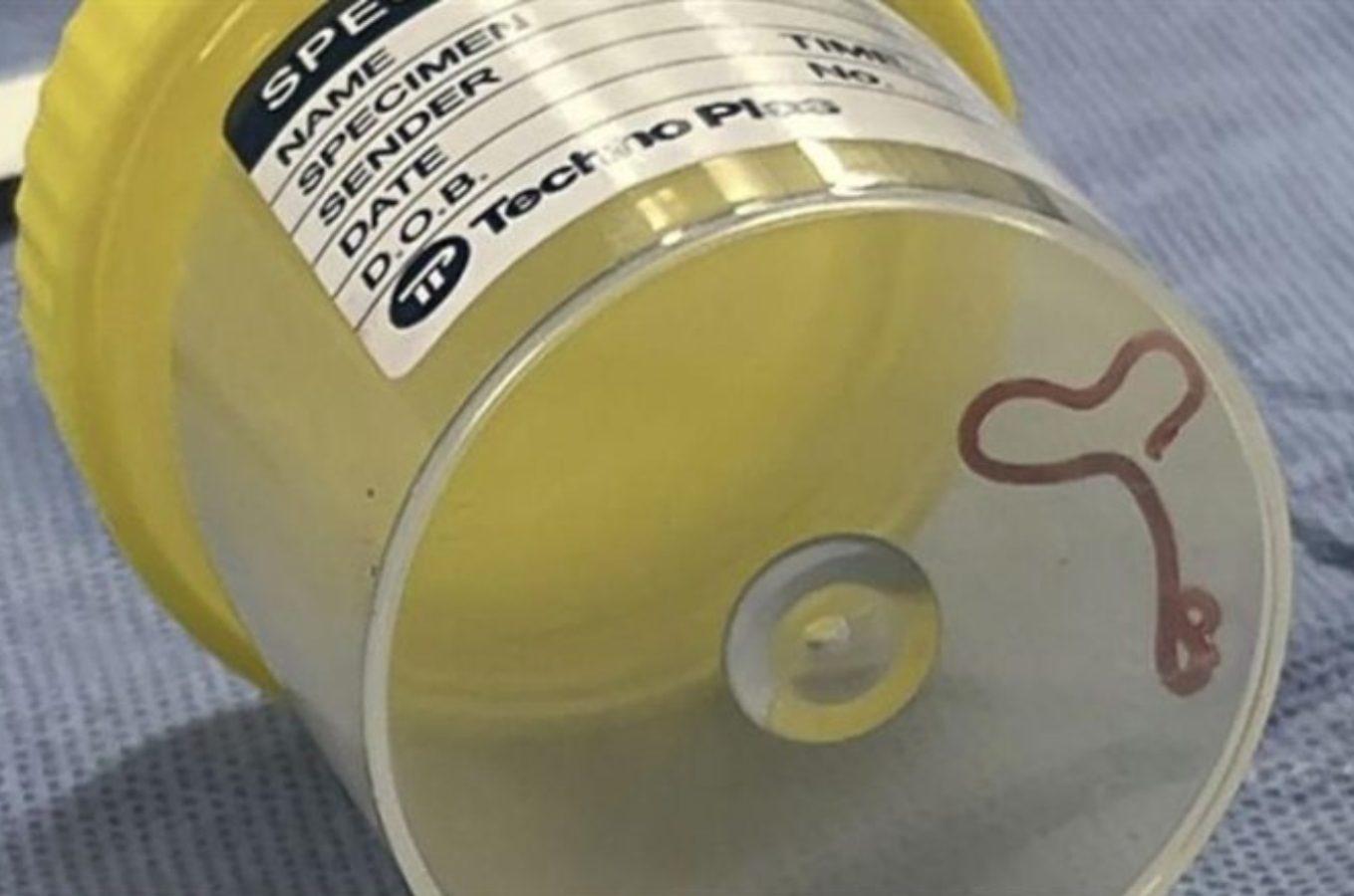 Ζωντανό σκουλήκι, 8 εκατοστών, βρέθηκε στον εγκέφαλο γυναίκας