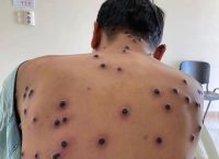 Mpox – ΕΟΔΥ: Όλα όσα πρέπει να γνωρίζουν οι ταξιδιώτες – Συμπτώματα και μέτρα προστασίας