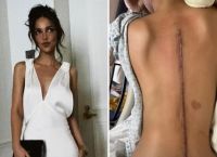 Κρουζ Μπέκαμ: H 29χρονη φίλη του δείχνει την τεράστια ουλή στην πλάτη της – Έμαθα να ξαναπερπατάω