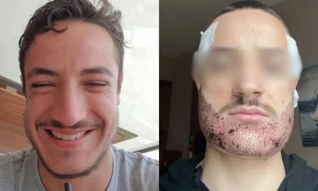 Γαλλία: 24χρονος αυτοκτόνησε μετά από αποτυχημένη επέμβαση για μούσια