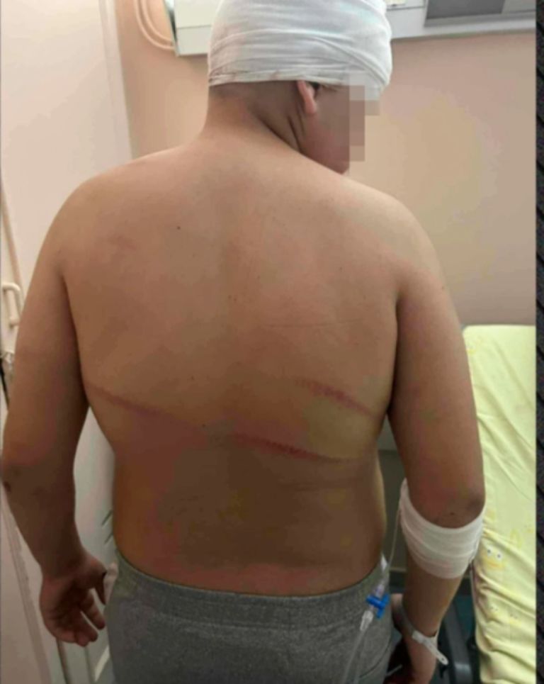 Θεσσαλονίκη: «Τον χτυπούσαν με μπετόβεργες, έχει τρύπες 15 πόντους στο κεφάλι»-Ξεσπά ο πατέρας του 13χρονου