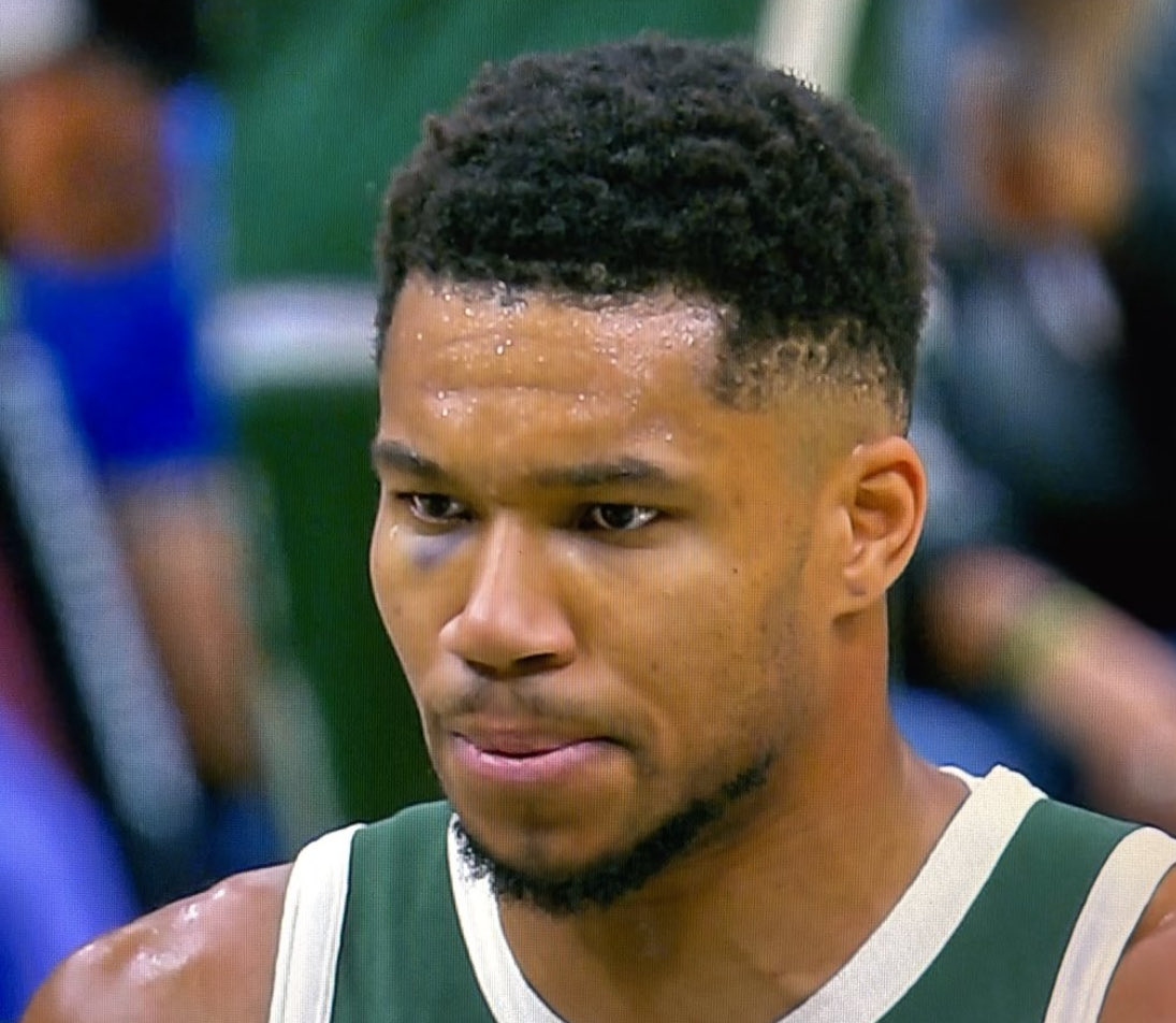 Τι συνέβη στον Γιάννη Αντετοκούνμπο – Η εξήγηση για το μαυρισμένο μάτι [vid]