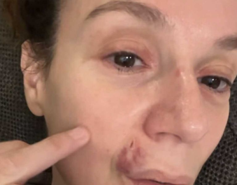 Σοκ! Με μαυρισμένο μάτι και αίματα στο πρόσωπο η Πέγκυ Τρικαλιώτη- Τι συνέβη [pics]