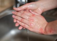 Ψωρίαση «βόμβα» υγείας μέχρι το 2050: Γιατί «χτυπά» περισσότερο τις πλούσιες χώρες