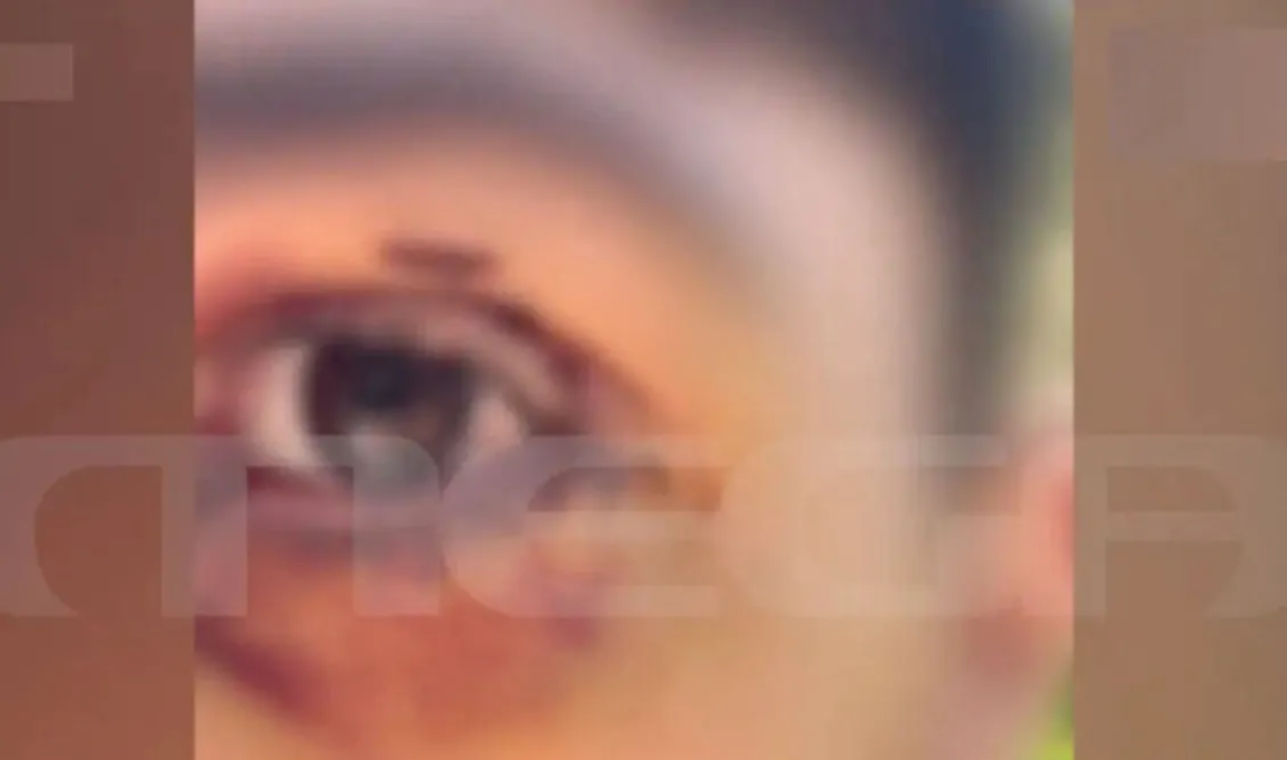 Ιωάννινα: Έστησαν καρτέρι σε 16χρονο τον ξυλοκόπησαν άγρια και κινδύνευσε να χάσει την όρασή του [vid]