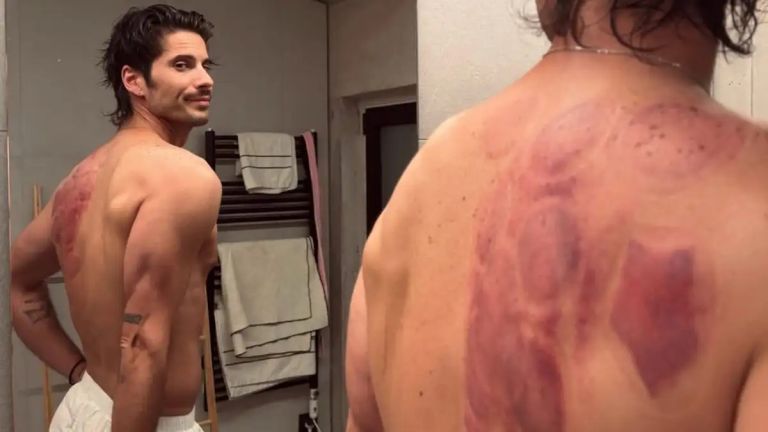 Σόκαρε ο Καράβας -Αποκάλυψε το πρόβλημα που έχει στην ωμοπλάτη